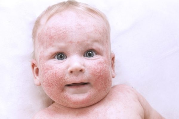 Как выявить аллергическое заболевание и узнать, на что аллергия у ребенка?
