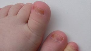 Как распознать грибок ногтей на ногах у ребенка (фото)?