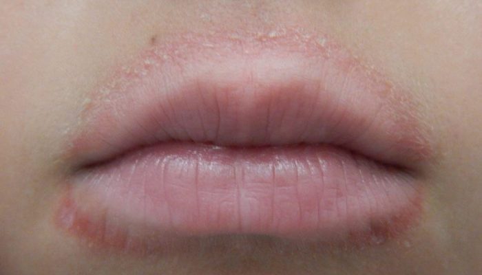 Дерматит на губах (хейлит): лечение