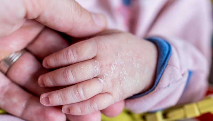 Почему у новорожденного шелушится кожа и что делать в этой ситуации?