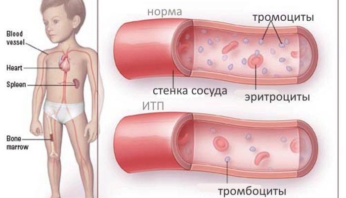 Как проявляется и лечится тромбоцитопеническая пурпура? Отвечаем на сложные вопросы