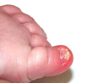 Как распознать грибок ногтей на ногах у ребенка (фото)?
