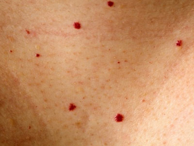 Высыпания на коже при болезни поджелудочной железы - рубиновые пятна