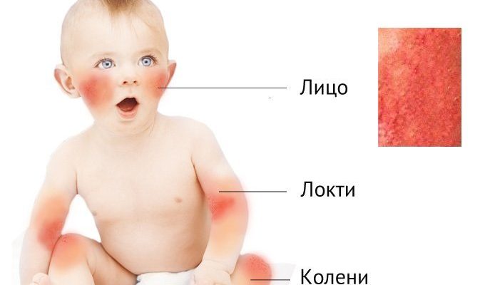 Список эмолентов при атопическом дерматите у детей и взрослых, а также правила их применения