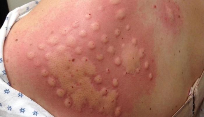 Аллергия на одежду: причины и лечение