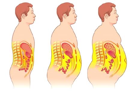 Висцеральное ожирение и его последствия
