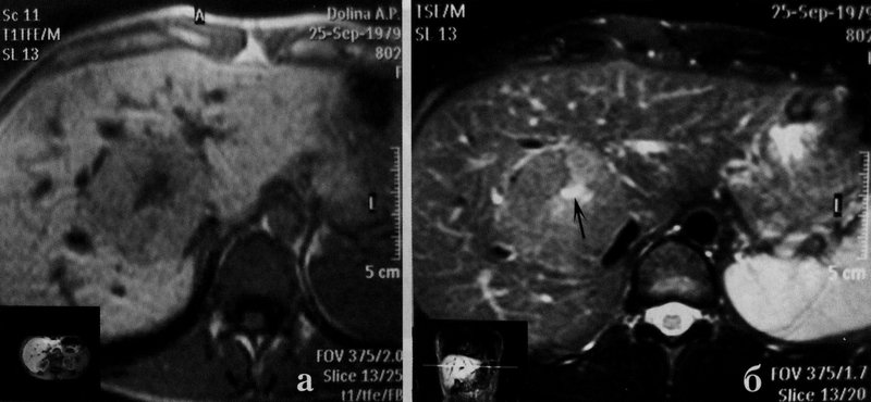 Узловая гиперплазия печени на МРТ