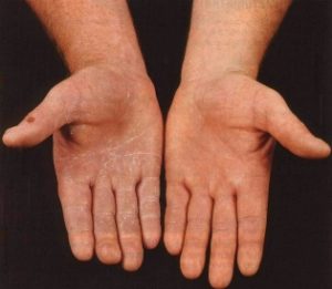 Симптомы грибка на коже рук, как его лечить и больше не заразиться