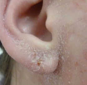 Почему шелушится кожа в ушах и на их поверхности