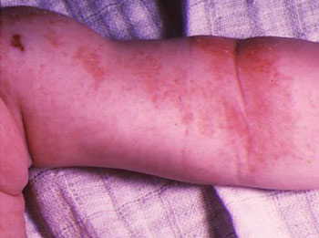 высыпания на теле у ребенка при атопическом дерматите