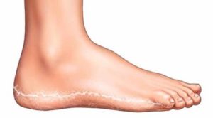 Как проявляется грибок на ногах: первые симптомы