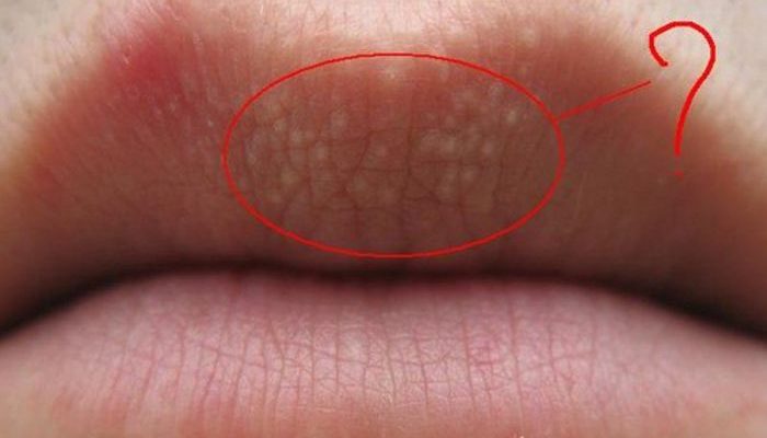 Что означают белые точки на губах и как их убрать? Отвечают эксперты