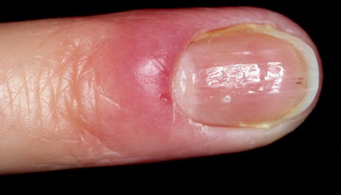 Нарыв на пальце возле ногтя: как лечить?
