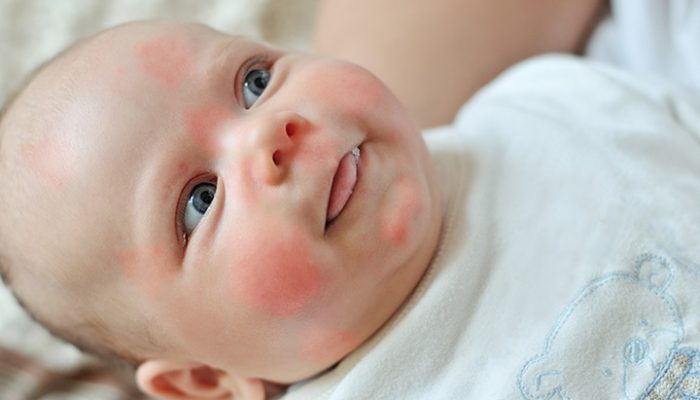 Аллергия на яичный белок у ребенка: симптомы