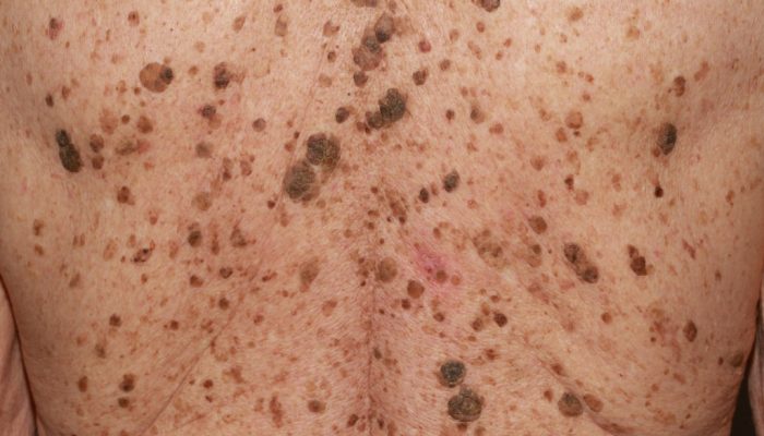 Кератоз кожи: симптомы и лечение