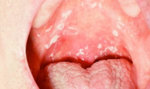 кандидоз полости рта у взрослых и детей: симптомы и лечение