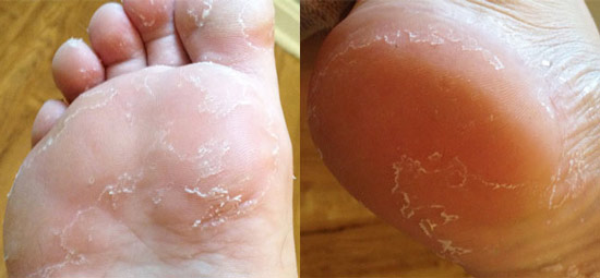 Причины и способы устранения шелушения кожи на ногах