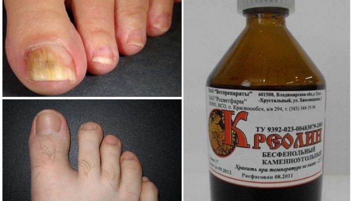 Лечение грибка ногтей Креолином