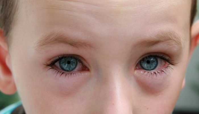 Почему появляется и как выглядит аллергия на глазах? Лечение таблетками, местными и народными средствами