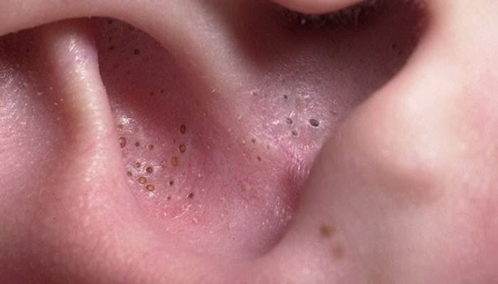Причины появления и методы удаления черных точек в ушах: простые способы лечения