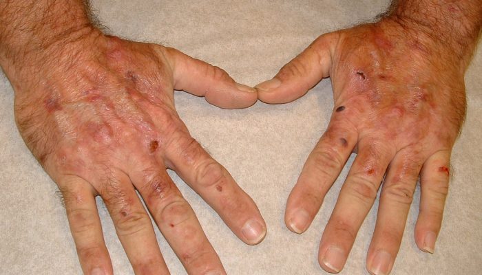 Пятна и другие симптомы болезней печени на коже: как поставить диагноз?