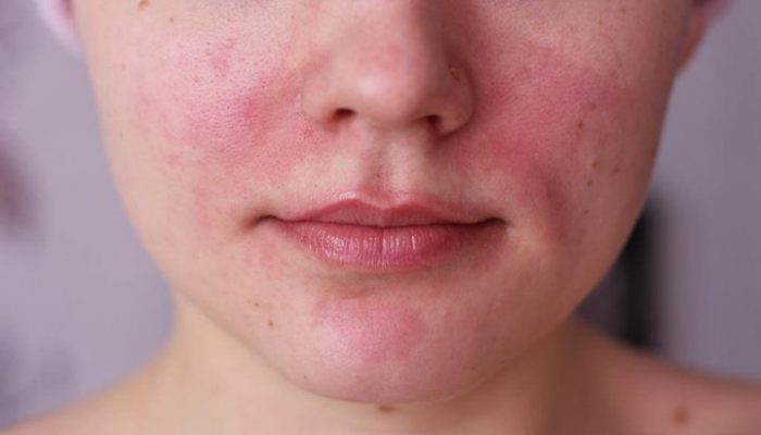 Покраснение и чешется кожа на лице: как снять раздражение? Разбираем эффективные методы
