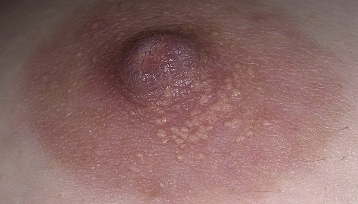 Как выглядят гранулы Фордайса на губах и половых органах? Следует ли их лечить?