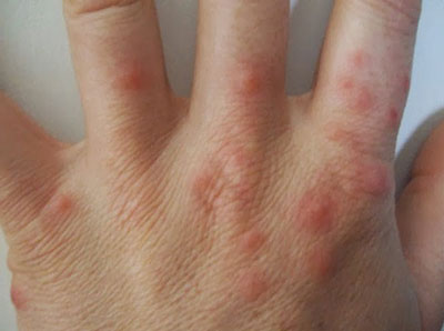Высыпания на руках при аллергии