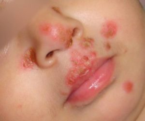 Почему паразит появляется на поверхности кожи у взрослых и детей?
