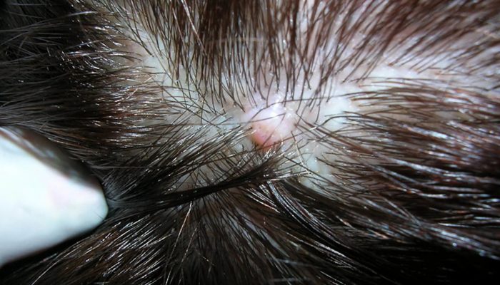 Фурункул на голове в волосах: лечение