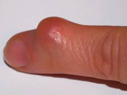Болезненное уплотнение на пальце руки под кожей thumbnail