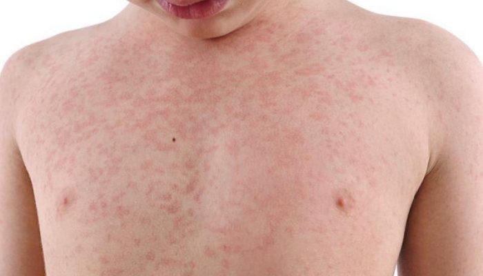 то такое вирусные заболевания кожи? Классификация кожных болезней и краткий обзор