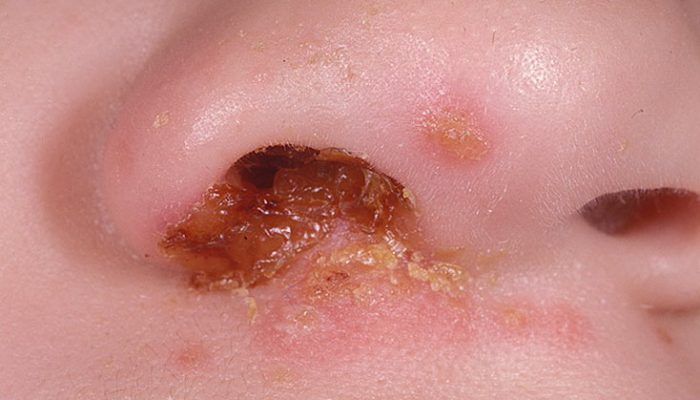 Стрептококковая инфекция на коже и в носу