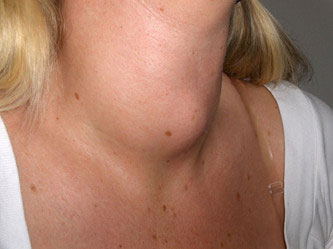 Уплотнение на шее в виде шишки: почему появляется, как от нее избавиться, и опасная ли она?