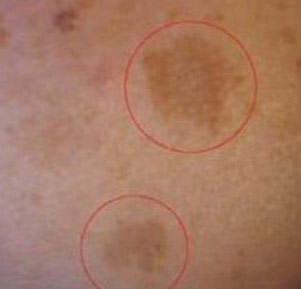 Как бороться с гиперпигментацией кожи - заболеванием, характеризующимся нарушенным цветом кожи и появлением коричневых пятен.