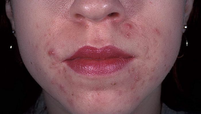 Себорея и себорейный дерматит на лице: причины и лечение