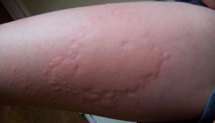 Причины уртикарных высыпаний на коже