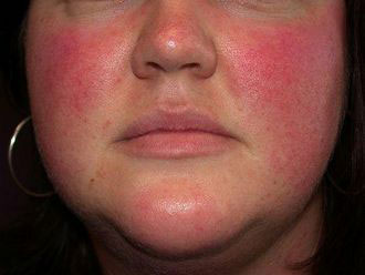 Аллергия красные щеки и сыпь thumbnail
