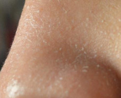 Причины шелушения и покраснения кожи лица