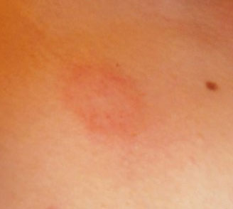 Красное пятно на плече у ребенка похожее на ожог thumbnail