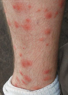Красные зудящие пятна на ногах после укусов насекомых