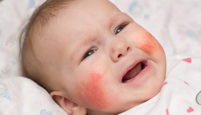 Почему возникает аллергия на морковь? Симптомы и лечение у ребенка и взрослого