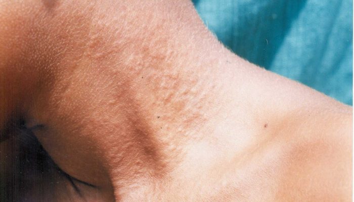 Почему образуется гусиная кожа? Как отличить ее от фолликулярного гиперкератоза? Методы лечения