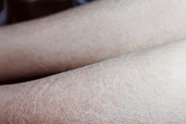 Сильное шелушение кожи тела: причины и лечение
