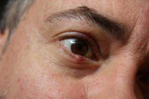 Лечение ячменя на глазу