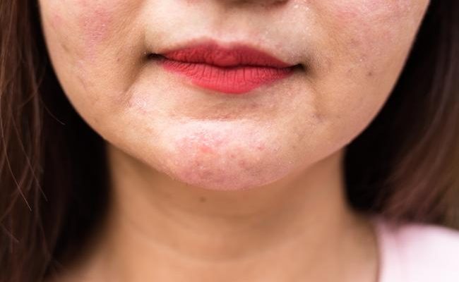 Как проявляется и лечится аллергия на косметику? Советы по выбору гипоаллергенных средств