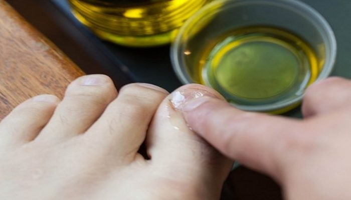 Как применять масло чайного дерева от грибка ногтей? Польза и противопоказания