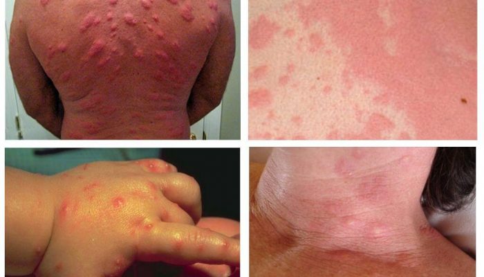 Почему возникает аллергия на укусы постельных клопов и как ее лечить?