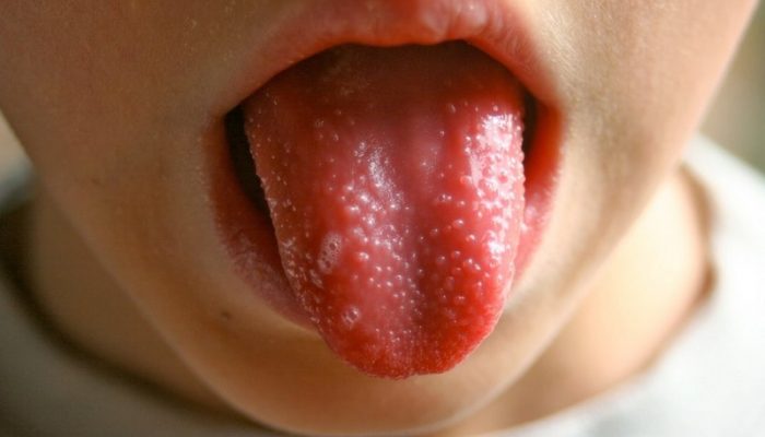Почему на языке появляются пупырышки и налет? Причины у детей и взрослых, методы лечения
