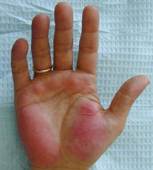 Красные ладони рук: о каком заболевании говорит симптом, и как от него избавиться?